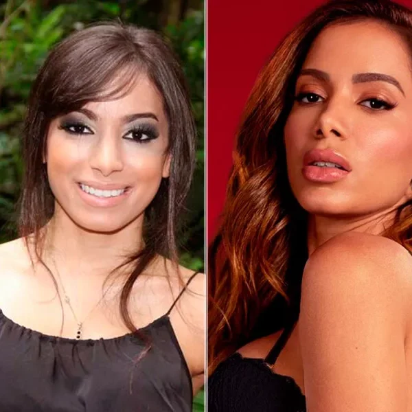 Anitta antes e depois da rinoplastia